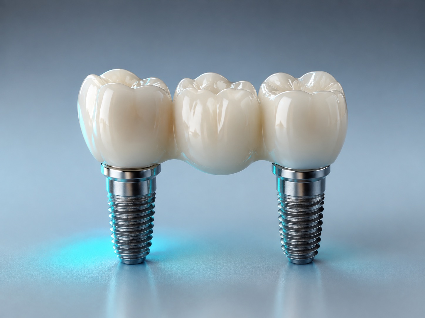 Ilustración de un puente dental sobre implantes